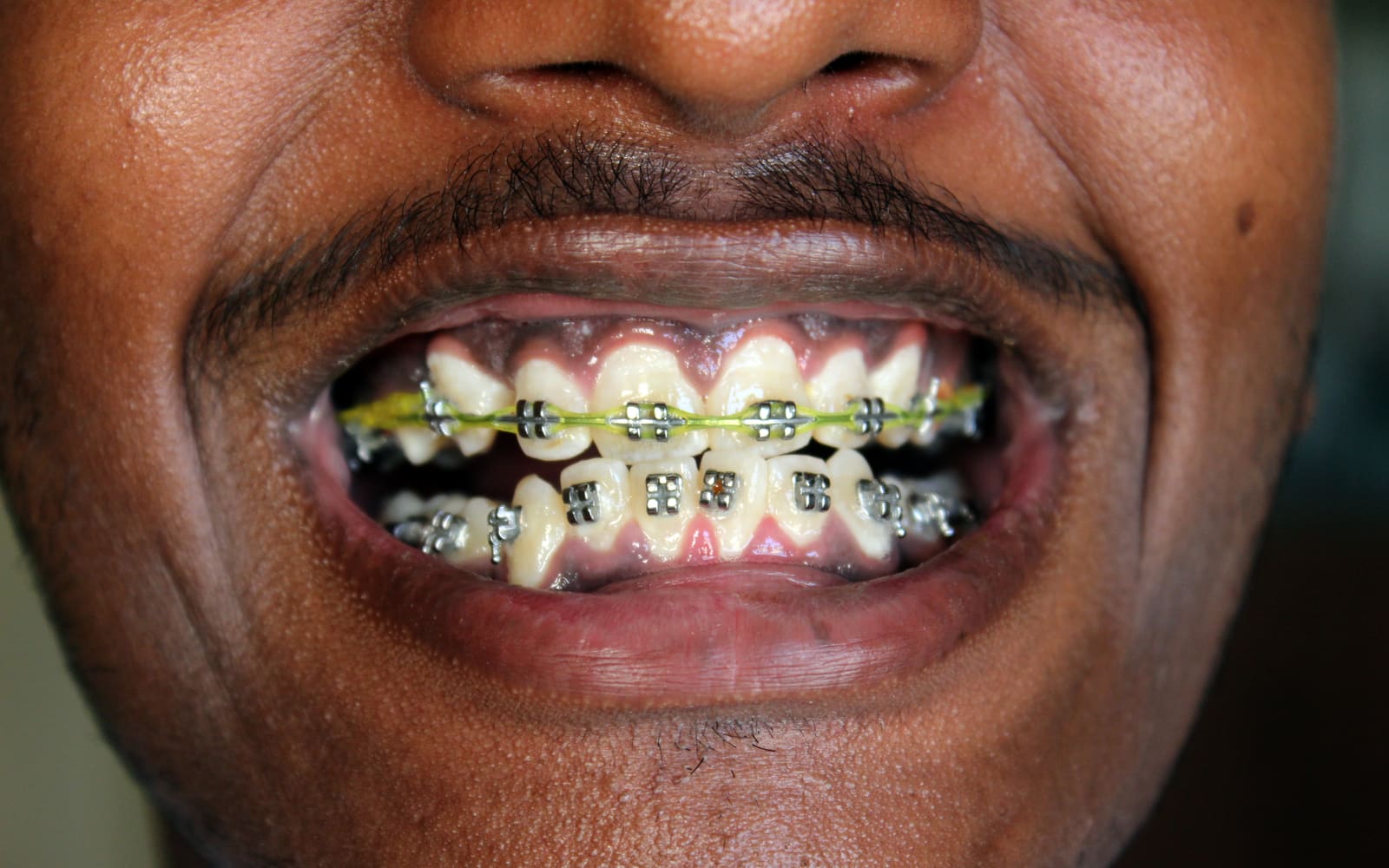 Clear Aligners