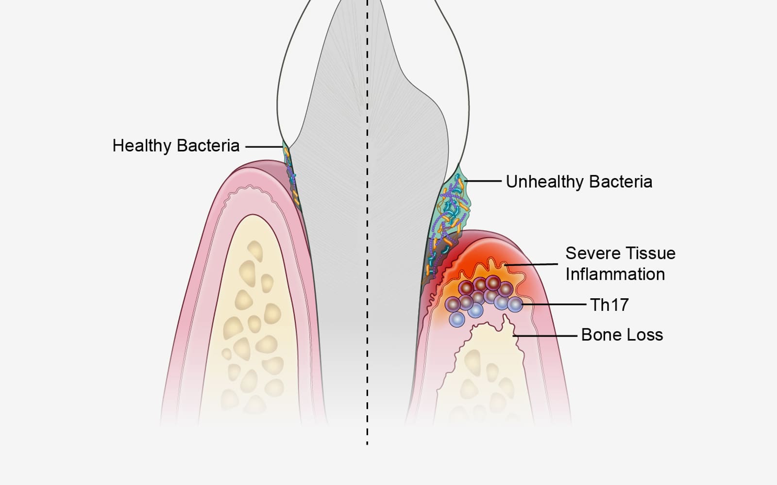 Swollen Gums and Dental Abscess Treatment in Gurgaon