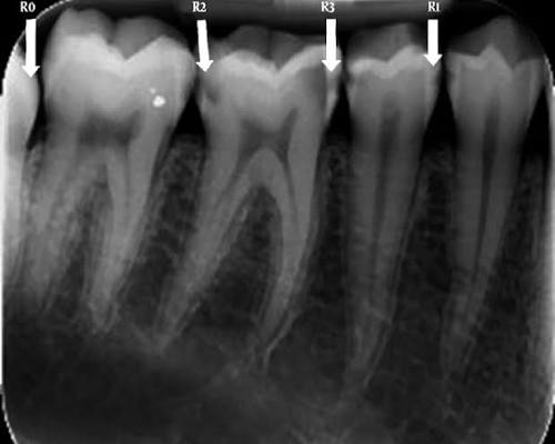 Digital dental X-ray showing a tooth with deep caries